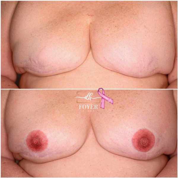 obojstranná areola onkologická pacientka
