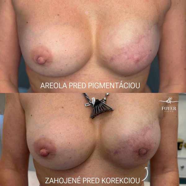 zahojená areola pred korekciou