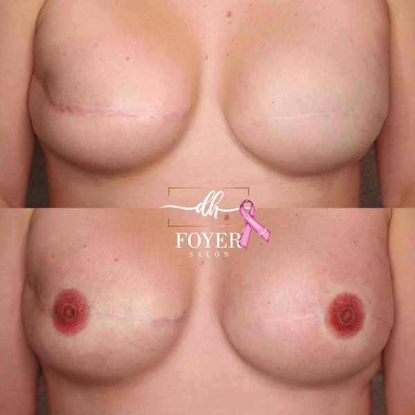 AREOLA na oboch prsníkoch po rakovine