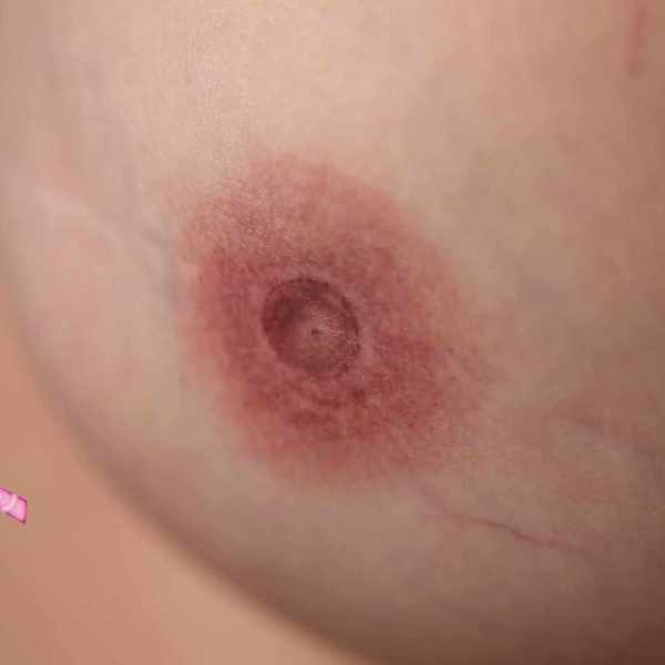zahojena 3D areola pre onko pacientku