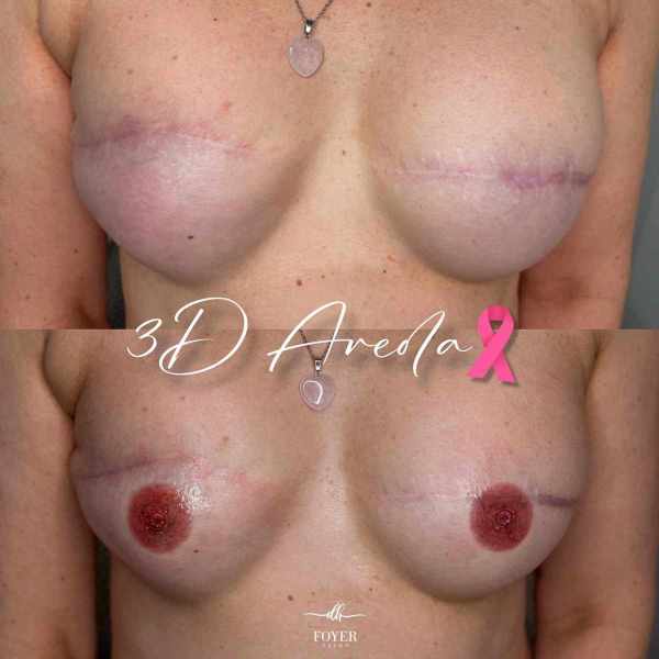 onko 3D areola