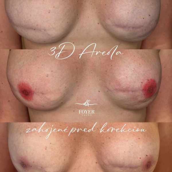 onko 3D areola