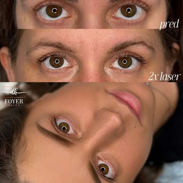 LASER REMOVAL