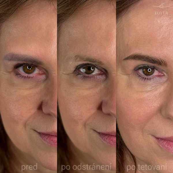 LASER REMOVAL