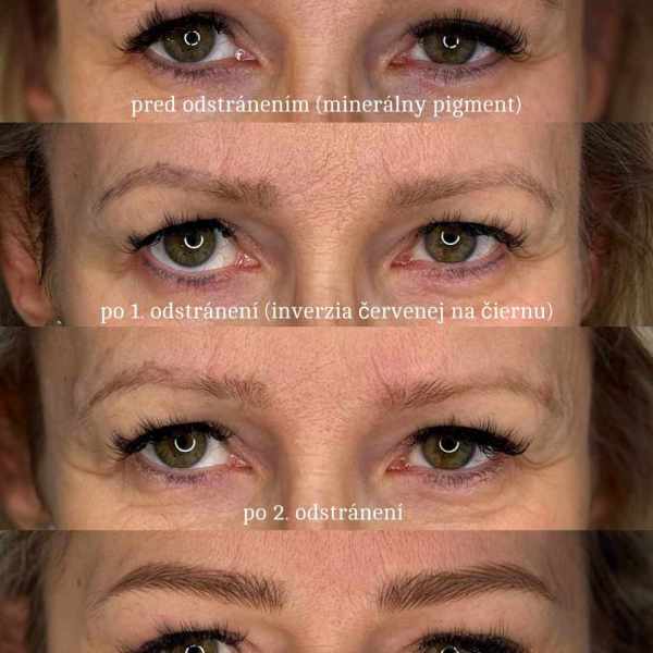 LASER REMOVAL
