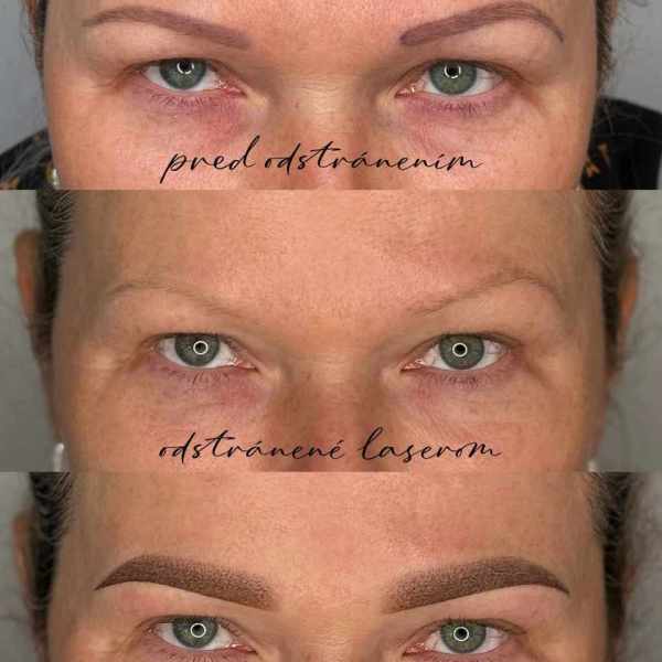 LASER REMOVAL