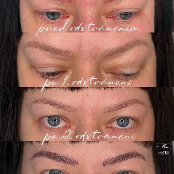 LASER REMOVAL