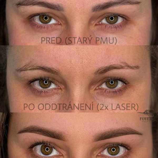 LASER REMOVAL