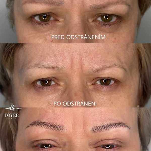 LASER REMOVAL