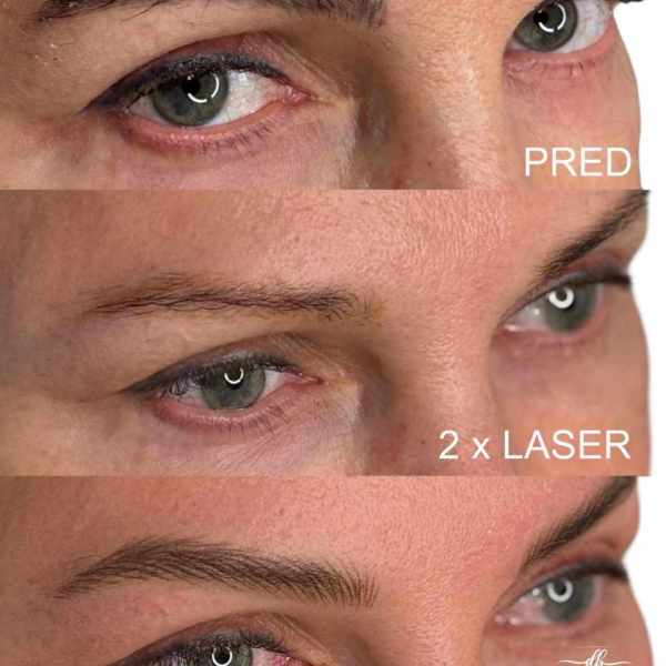LASER REMOVAL