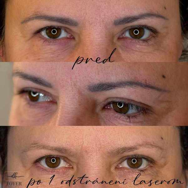 LASER REMOVAL