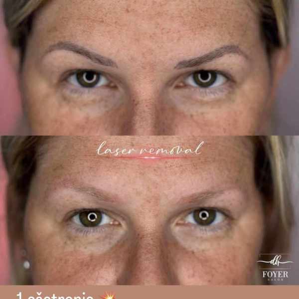 LASER REMOVAL