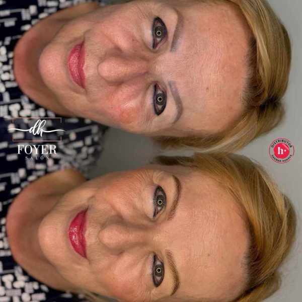 LASER REMOVAL