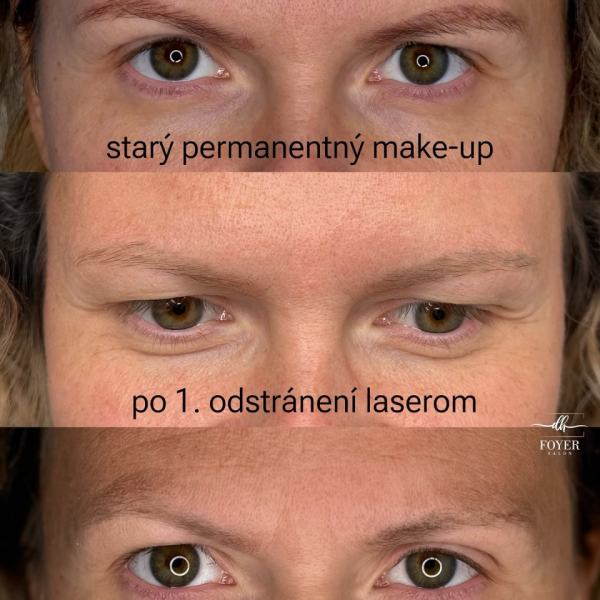 LASER REMOVAL