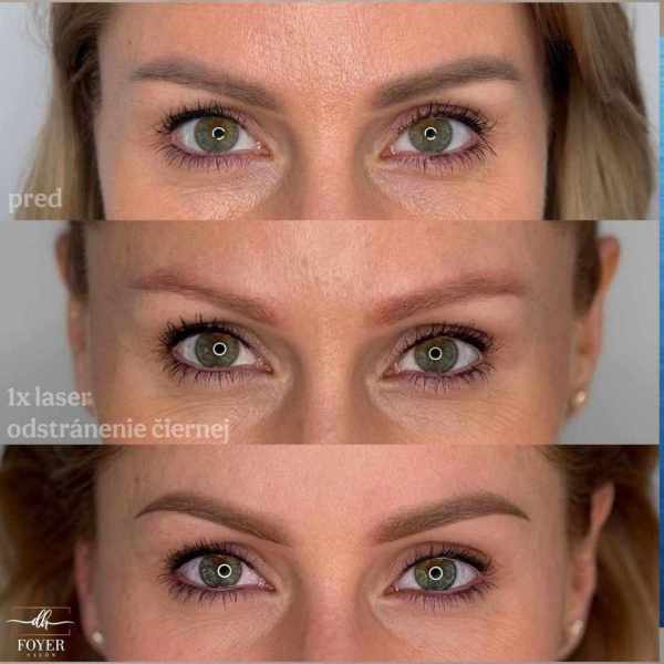 LASER REMOVAL