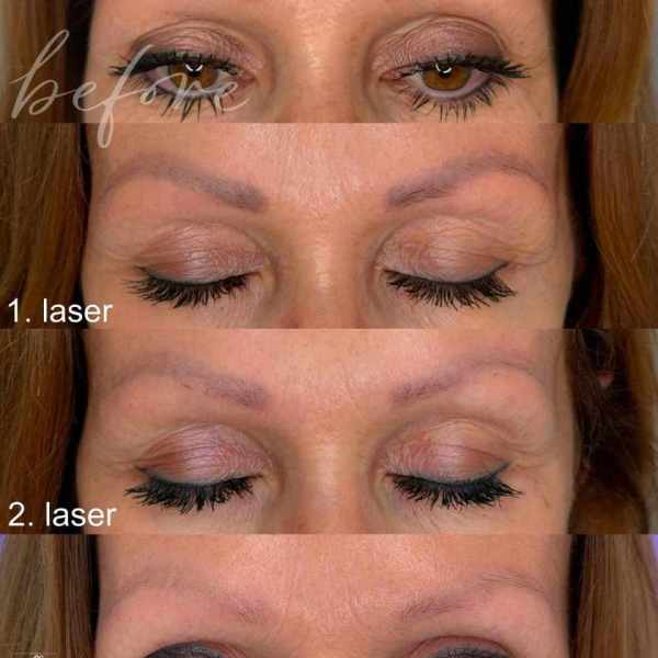LASER REMOVAL