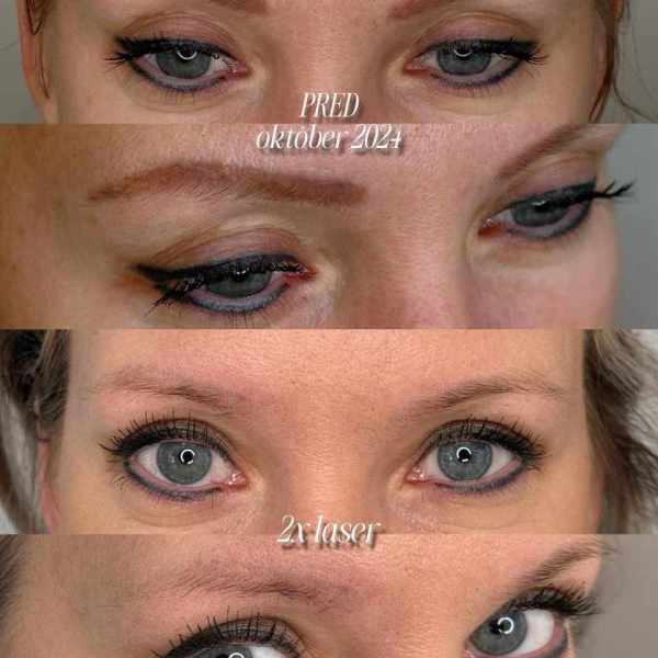 LASER REMOVAL